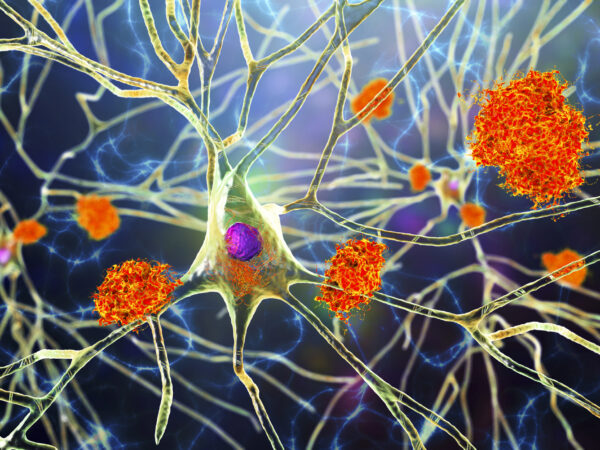 Neuron in Alzheimer